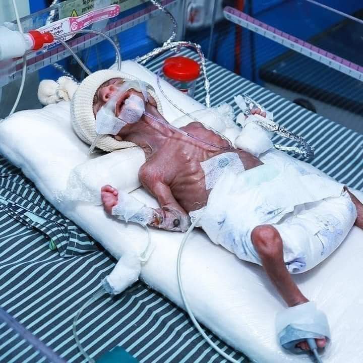 MellathM's tweet photo. #Tigraygenocide
#EndTigraySiege 
#ReconnectTigray 
#AllowHumanitarianAidToTigray 
#Stoptigraymassarrest
#Demandjusticefortigray
So Sad look at the Tigray children suffer too much due to no medicine supply. By manmade starvation tigray people dying. #worldactnow.
💔💔😭😭 https://t.co/0cGNO90dZP