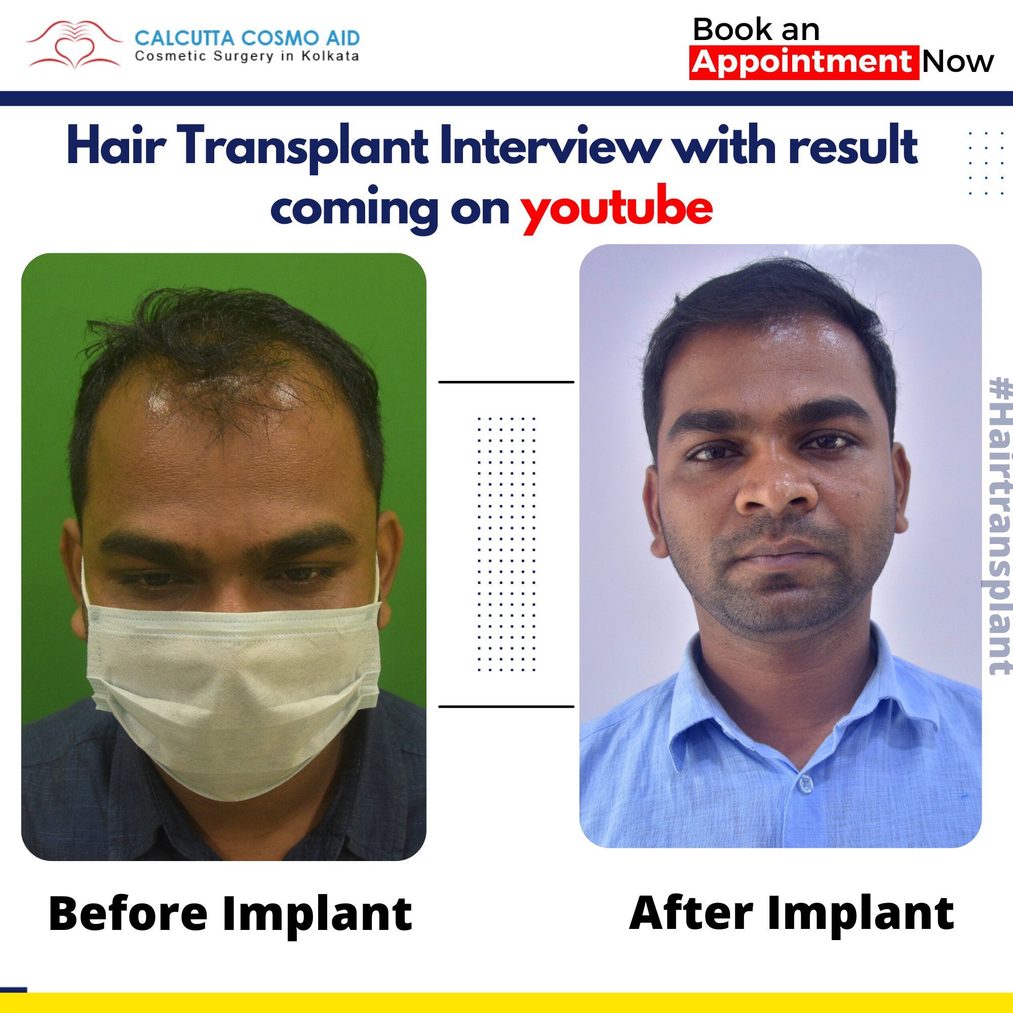 Dr Anand K Nagwani - Hair Transplant on Twitter: 