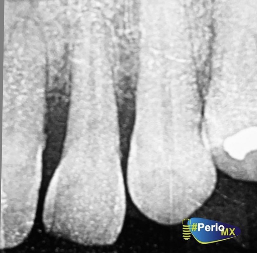 PerioMX's tweet photo. Recuerda tomar una serie radiográfica para observar si hay pérdida de inserción ✅

Excelente fin de semana!! 🦷

#periomxacademy #perioGO #perioMX #Periotalks #dentista #odontologia #dentist #online #periodontology #periodoncia #protesisdental #cirugia #dentistlife https://t.co/iqqgLIT1Vi