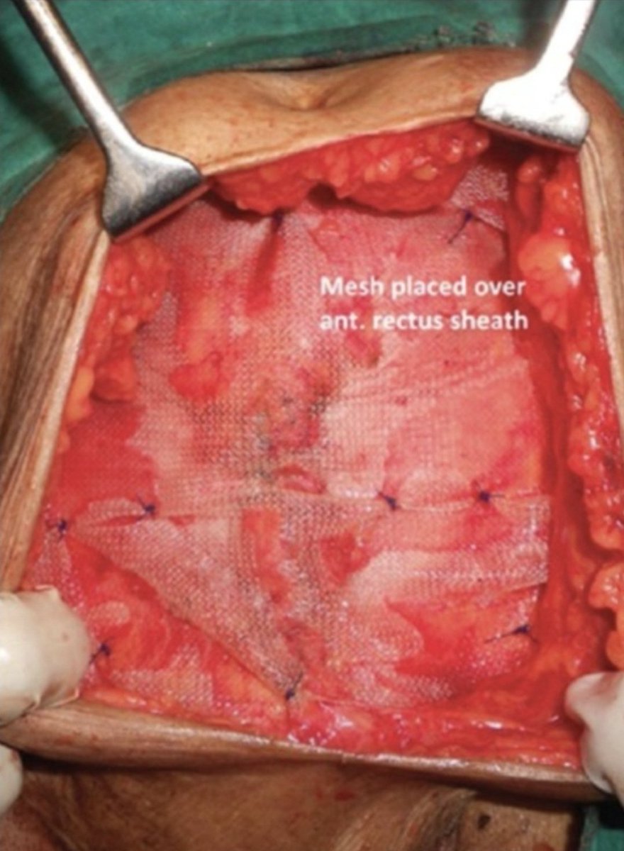 This was my mesh, a Coviden Pariatex Polyester mesh which was wrongfully placed on top of my bowel. Causing everything it touched to stick together. I can't stand, walk or bend over without constant chronic pain every single day. Not good enough to be left in this condition.