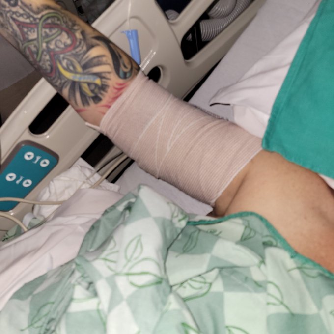 Home from the hospital. Arms are by far worse then my stomach. Just trying to keep myself asleep as much<a href="/tag/mvsales"class="tags"><span>#mvsales</span></a>