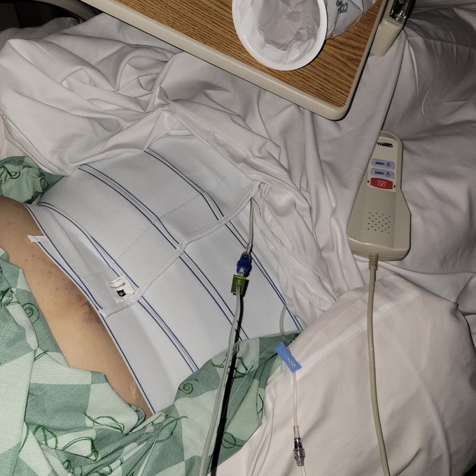 Home from the hospital. Arms are by far worse then my stomach. Just trying to keep myself asleep as much<a href="/tag/weightloss"class="tags"><span>#weightloss</span></a><a href="/tag/weightlosstransformation"class="tags"><span>#weightlosstransformation</span></a><a href="/tag/gastricsleeve"class="tags"><span>#gastricsleeve</span></a>
