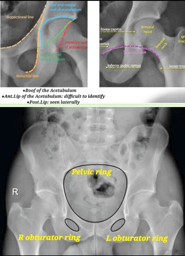 𝘿𝙧.𝙊𝙈𝙄𝘿 𝘽𝘼𝙉𝘿𝘼𝙍𝘾𝙃𝙄 𝙈.𝘿. on Twitter "🛑In AP pelvic radiograph simply