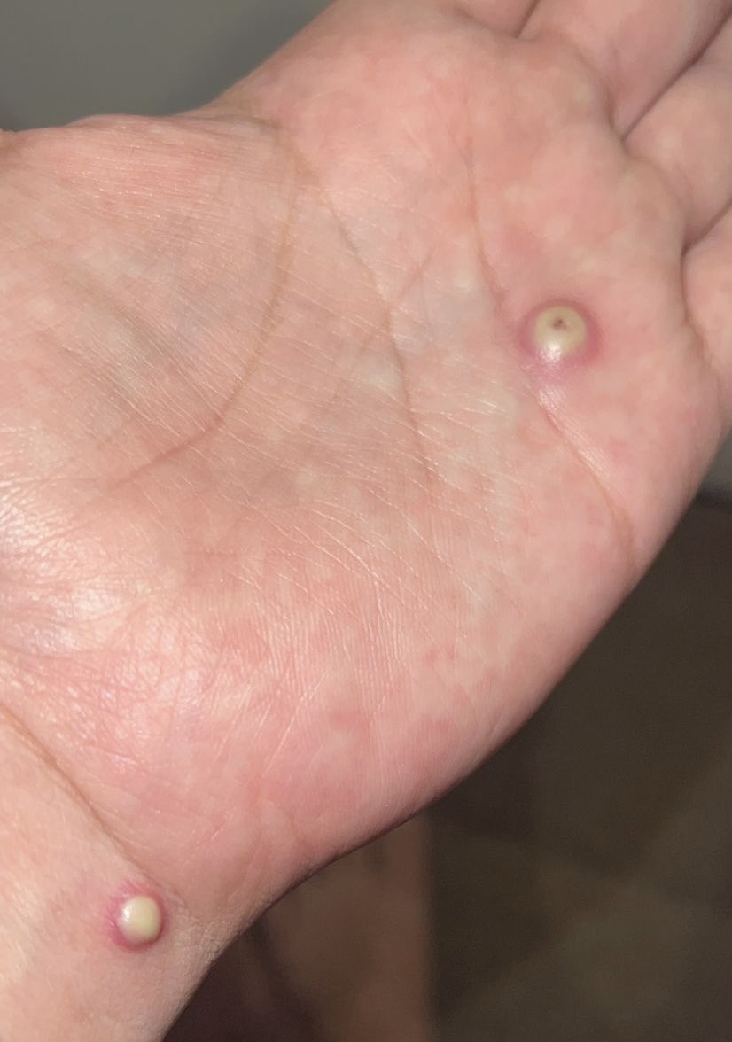 OJO!!! VIRUELA DEL MONO: Es muy importante que pacientes identifiquen lesiones típicas  de esta enfermedad en la piel! Les dejo fotos(previa autorización) de algunos de mis pacientes en fase pústula Si presentas algo similar posterior a una exposición de riesgo acude a tu médico!