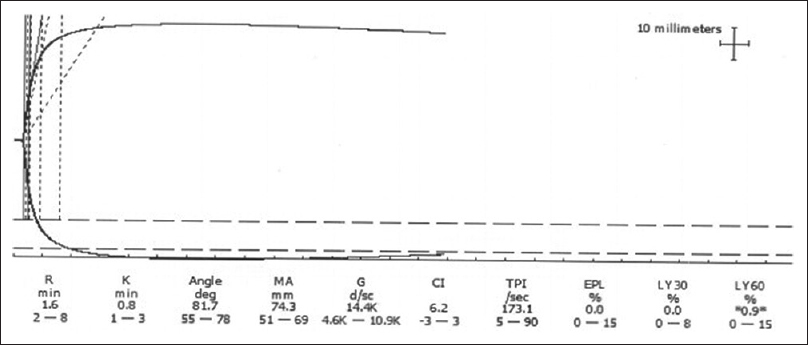 Illustration: Thromboelastography – A useful tool to monitor COVID-19-associated coagulopathy Vaidya A, Paonam B, Mohan G, Shastry S - Asian J Transfus Sci. @DoRMAHE_Manipal @Dr_GaneshMohan @AshwinVaidya13 @MAHE_Manipal @ShameeShastry @AABB @HermelinMD. ajts.org/article.asp?is…