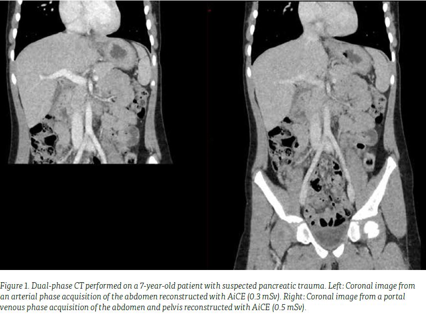 CanonMedicalANZ's tweet image. Visit bit.ly/3zdSF7Y to gain insights on how #DeepLearningReconstruction in #CT, powered by Altivity, leads to low-dose, high-quality, and high-speed.

Courtesy of Dr. Richard Hawkins, Hospitals NHS Trust, Crewe, United Kingdom