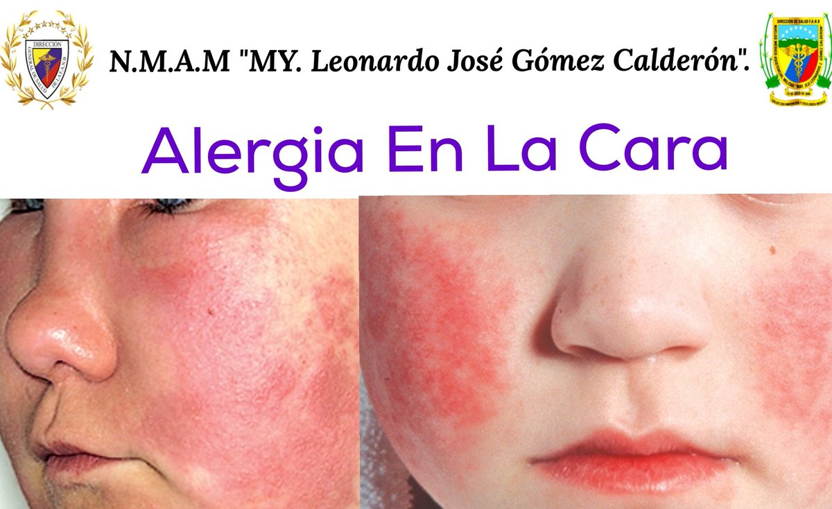 NMAMMYLEONARDO1's tweet photo. Alergia en la cara Las alergias aparecen cuando el sistema inmunitario reacciona ante una sustancia extraña (como el polen, el veneno de abejas o la caspa de las mascotas) o un alimento que no provoca una reacción en la mayoría de las personas.
@DigesaludFANB https://t.co/6CkyQ6XJp4