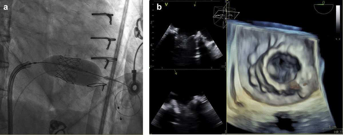 crfshj's tweet photo. Check out an interesting case featuring #VIV #TMVR using #4DEcho and the novel NuVision ICE catheter under conscious sedation.
https://t.co/nlCO2UerS3 @BhardwajBhaskr @HarshGMD @PDXHeartValveMD @OHSUNews @OHSUCardio #CardioResearch #structuralheartdisease #mitralvalve https://t.co/W1Rj1bwrqx