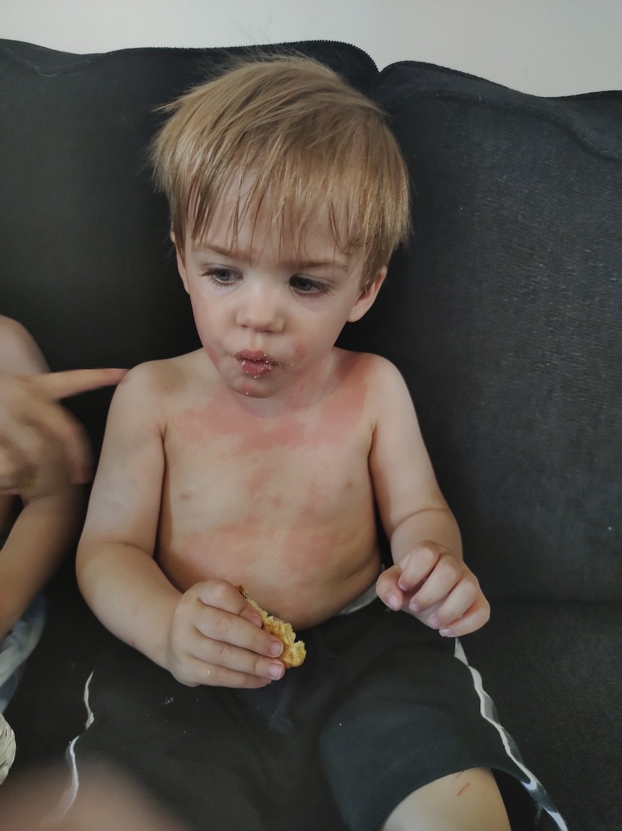 Not_so_unique's tweet photo. @LidlGB have you changed the ingredients in your Lupilu "sensitive" wet wipes? Wiped my boy down this morning, after getting sticky from playing and the exact area I wiped him with has come up in a rash 😩
Given him baby antihistamines &amp; 30mins later it's finally come down! Help! https://t.co/nUBbVQuM22