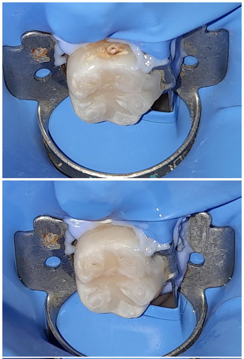 Dental24_7's tweet image. Eliminando caries que aparece entre los dientes (interproximal) #Prosthodontics #DirectComposite #EstheticDentistry #RestorativeDentistry #Dentista #Dental #Veneers #DentalVeneer #Dentistry #OdontologiaEstetica #Dentist #CosmeticDentistry #SmileMakeover #Odontología #DentalClinic