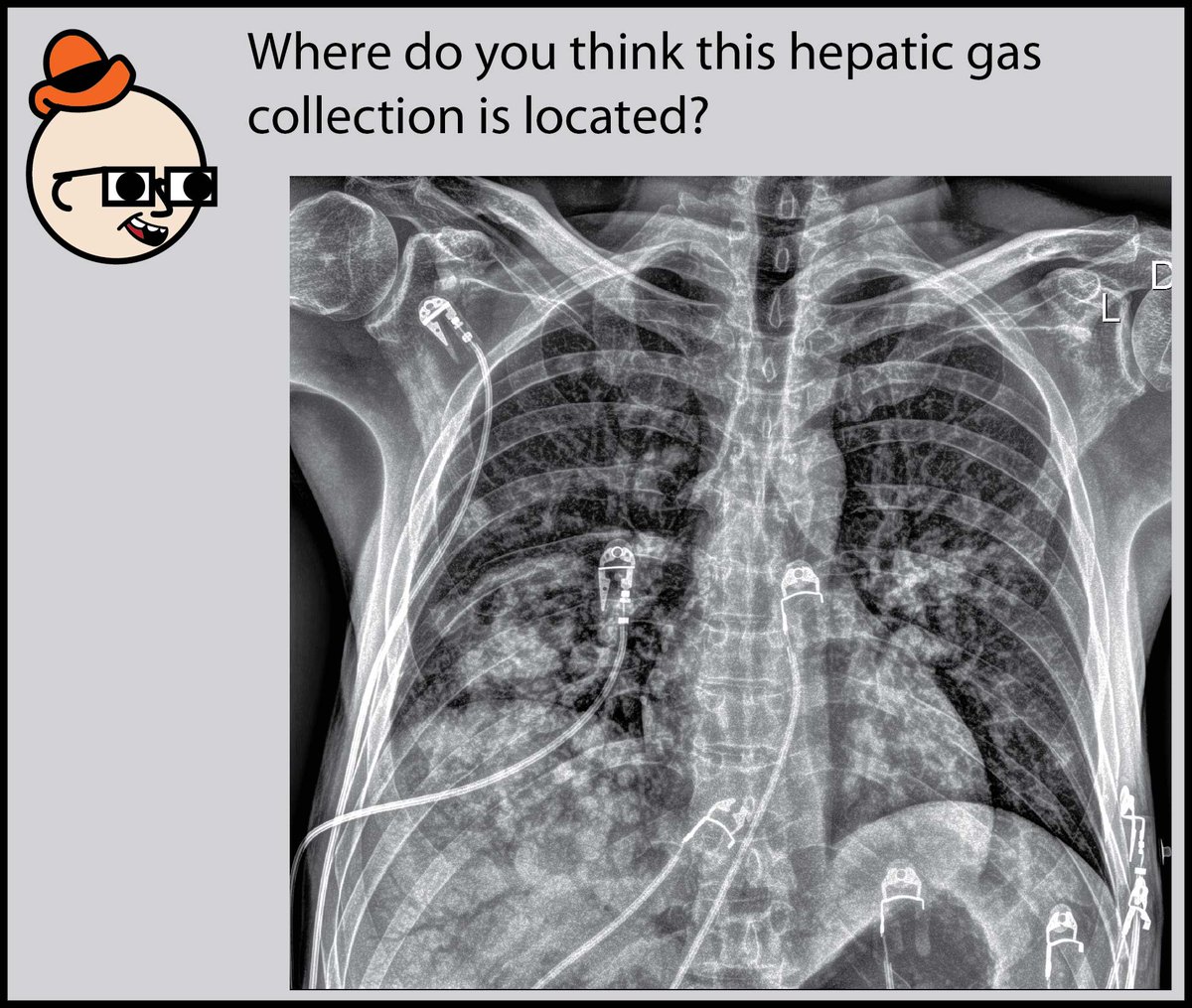 StefanTigges's tweet photo. We’ll journey to the strange land below the diaphragm and look at abnormal air collections! What life-threatening condition accounts for the radiographic findings.If you’d like to learn how to read chest X-Rays, check out my free comic: https://t.co/xhAMW41iMJ https://t.co/V6CKCm5tH8