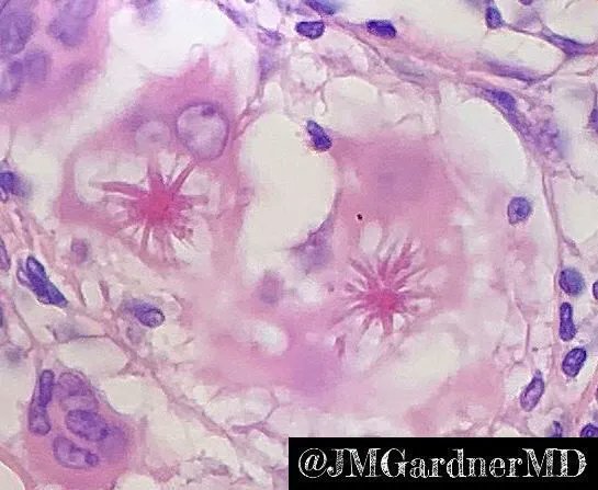 What are these gorgeous pink structures? Where are you most likely to find them (surprisingly, it's NOT sarcoidosis!)? Answer &amp; more pics here: kikoxp.com/posts/5569. #pathology #pathologists #pathTwitter #dermpath #dermatology #dermatologia #dermtwitter