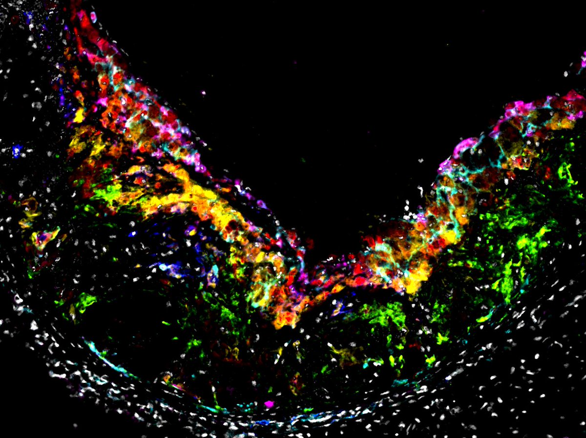 #Macrophage #heterogeneity is driven by microenvironmental factors undetected in RNAseq or cytometry approaches. By #imaging subsets in their natural habitat we can now also define their local #niche! #CellMetabolism #Multispectralimaging #Atherosclerosis
authors.elsevier.com/sd/article/S15…