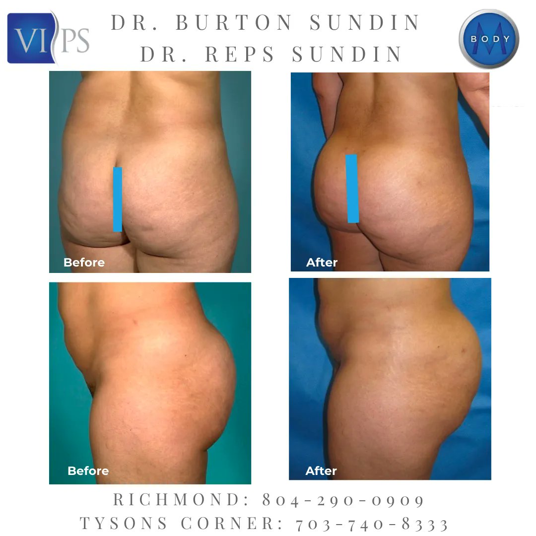 mbodycenter's tweet photo. This healthy young patient underwent a Brazilian Butt Lift with amazing results!
Call us today Tyson’s Corner (703) 740-8333  Richmond (804) 290-0909
#PlasticSurgery #Richmond #NorthernVirginia #VIPS #DrsSundin #TysonsCorner #ViennaVA #WashingtonDC #vienna #fairfax #arlington https://t.co/Cq0Rl0Yr6i