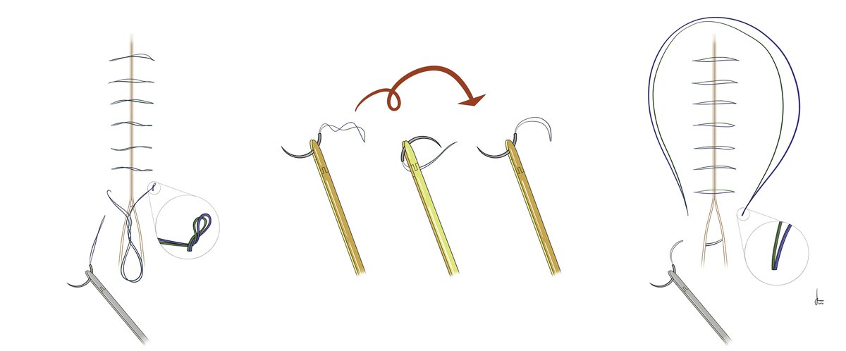 BJS (@bjsurgery) on Twitter photo Free to access in BJS' August issue: ‘Cambridge twist’: overlooked detail when teaching continuous sutures academic.oup.com/bjs/article/10… <a href="/AmyLightnerMD/">Amy Lee Lightner, MD</a> <a href="/bplwijn/">Bas Wijnhoven</a> <a href="/des_winter/">Des Winter</a> <a href="/ksoreide/">Kjetil Søreide</a> <a href="/MalinASund/">Malin Sund</a> <a href="/evanscolorectal/">Martyn Evans</a> <a href="/nfmkok/">Niels Kok</a> <a href="/robhinchliffe1/">Robert Hinchliffe</a> <a href="/young_bjs/">Young BJS</a> Free to access in BJS' August issue: ‘Cambridge twist’: overlooked detail when teaching continuous sutures academic.oup.com/bjs/article/10… <a href="/AmyLightnerMD/">Amy Lee Lightner, MD</a> <a href="/bplwijn/">Bas Wijnhoven</a> <a href="/des_winter/">Des Winter</a> <a href="/ksoreide/">Kjetil Søreide</a> <a href="/MalinASund/">Malin Sund</a> <a href="/evanscolorectal/">Martyn Evans</a> <a href="/nfmkok/">Niels Kok</a> <a href="/robhinchliffe1/">Robert Hinchliffe</a> <a href="/young_bjs/">Young BJS</a>