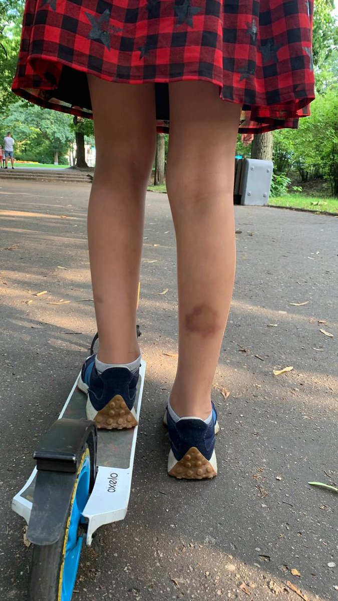 Дачка так сумуе па радзіме... Нават сінякі нагадваюць аб ёй.