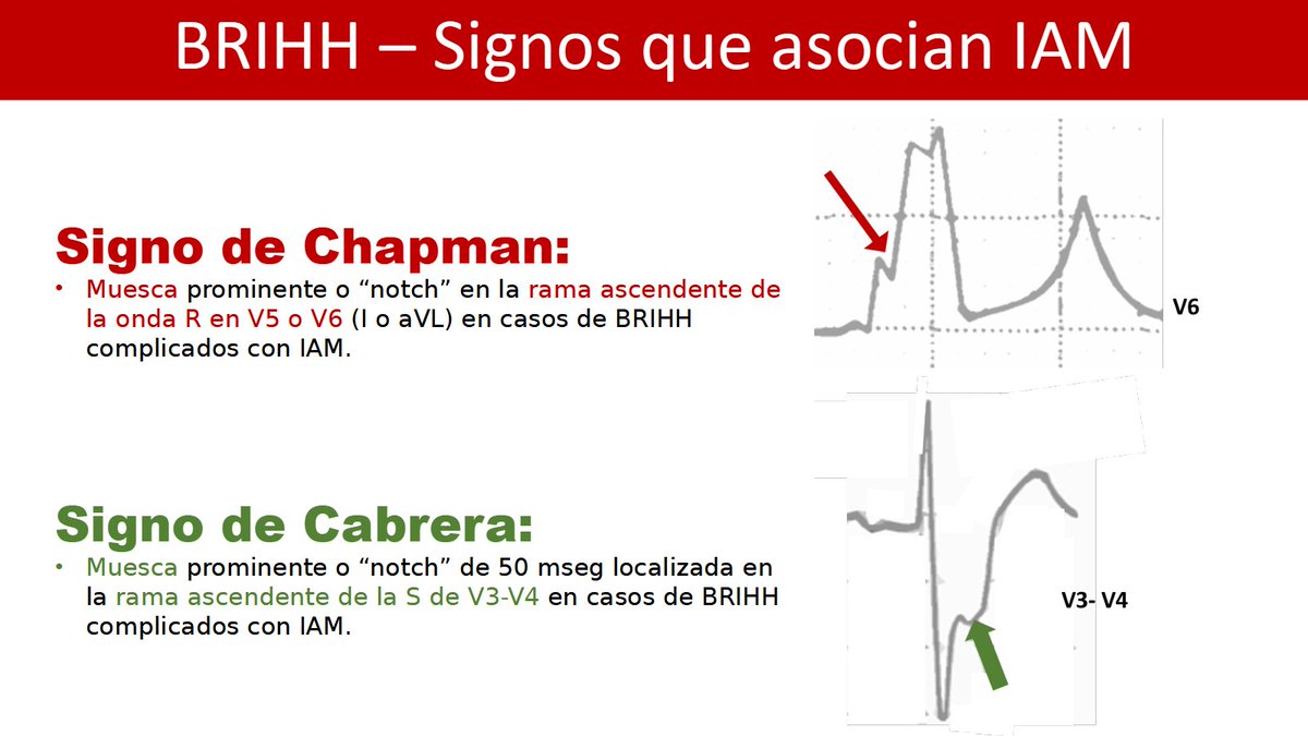 CardioAPFerrol's tweet photo. El BRIHH puede dificultar la interpretación del ECG📈 en pacientes con sospecha de Sd. coronario agudo ❤️‍🩹
Además de los criterios de Sgarbossa (que repasamos aquí ➡️ https://t.co/XgDNoWhxZX) tenemos dos signos con nombre propio que se asocian a IAM en pacientes con BRIHH ⬇️⬇️ https://t.co/PG5PtvBHxR