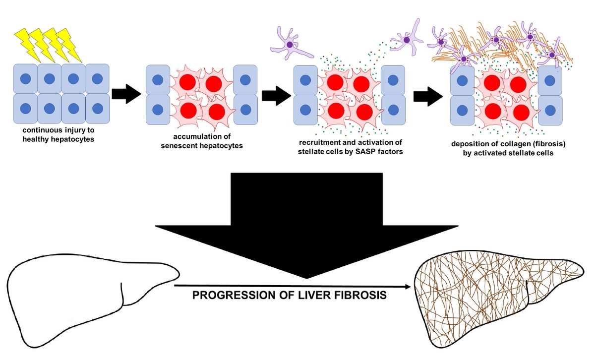 NottsLiverTeam's tweet photo. Here’s our provocative hypothesis-generating study demonstrating a direct and causal relationship between #hepatocyte #senescence and #LiverFibrosis, driven by SASP factors, potential #antifibrotic therapeutic target.
Read it here: https://t.co/ojYJVYi3If
#LiverTwitter https://t.co/abK4EQD5qv