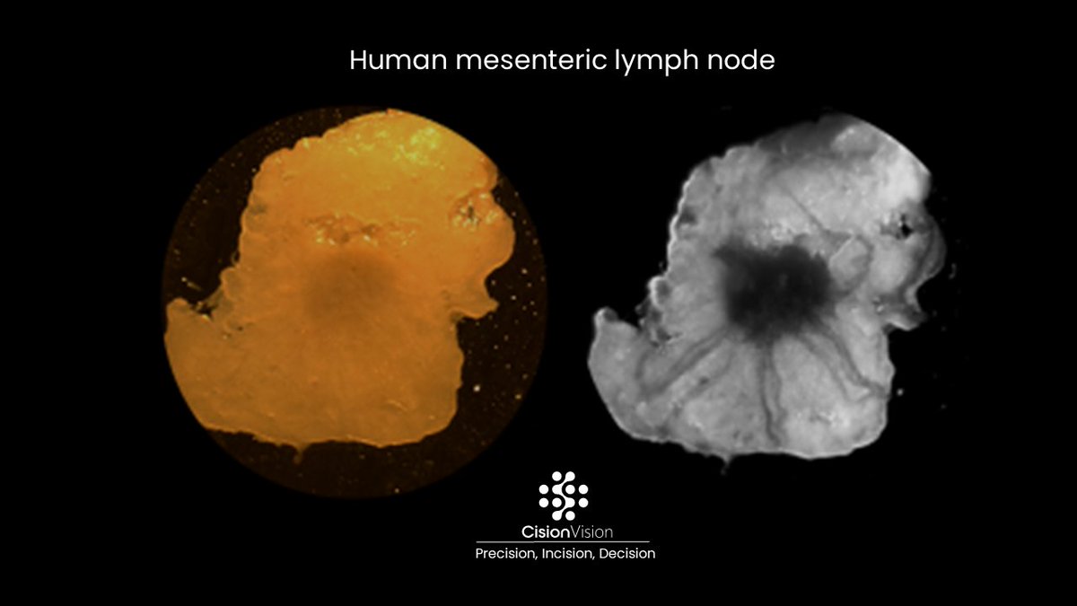 Lymph nodes are critically important for cancer diagnosis and staging. They are, however, extremely difficult to find because of their translucent color. Our breakthrough imaging technology visualizes lymph nodes in real time without injection or radiation.#cancercare