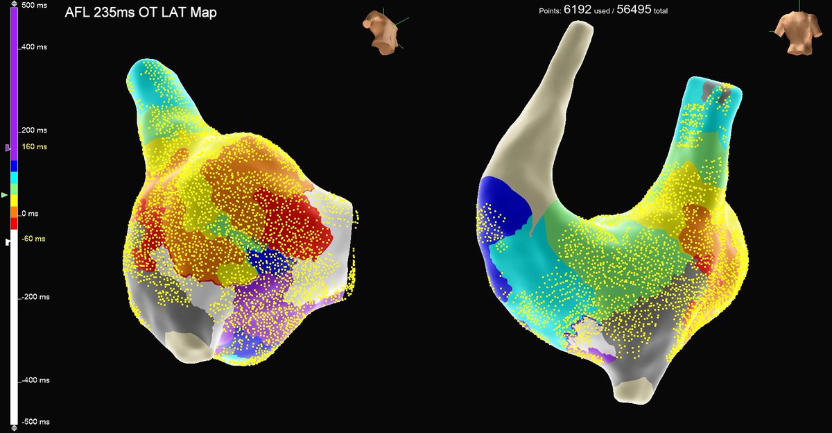 murphy_lzy's tweet photo. Back to the field
Dilated RA post ASD surgery, left-sided SVC
Initial AFL 235ms mapped #OnlyWithOT &amp; #HDGrid
How many loops have you found from the isochronal map?
#AbbottEmp #EPeeps https://t.co/2YF78ftrAi