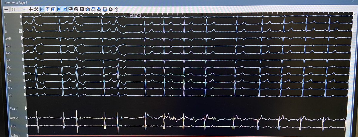 Very quick and satisfying case with @ashu18383. Bigeminal PVCs quickly mapped to Anterior Lateral MVA with #HDGrid. Instantaneous suppression on first RFA application. Map Credit: <a href="/BrianOttoEP/">Brian Otto</a> <a href="/AbbottCardio/">Abbott Cardiovascular</a>