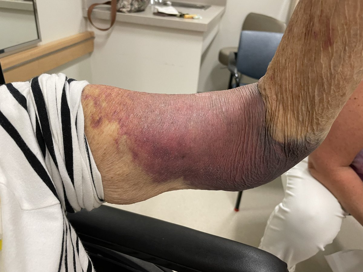 Spontaneous biceps rupture patient on anticoagulant for AF- a strong clue  for TTR amyloidosis!