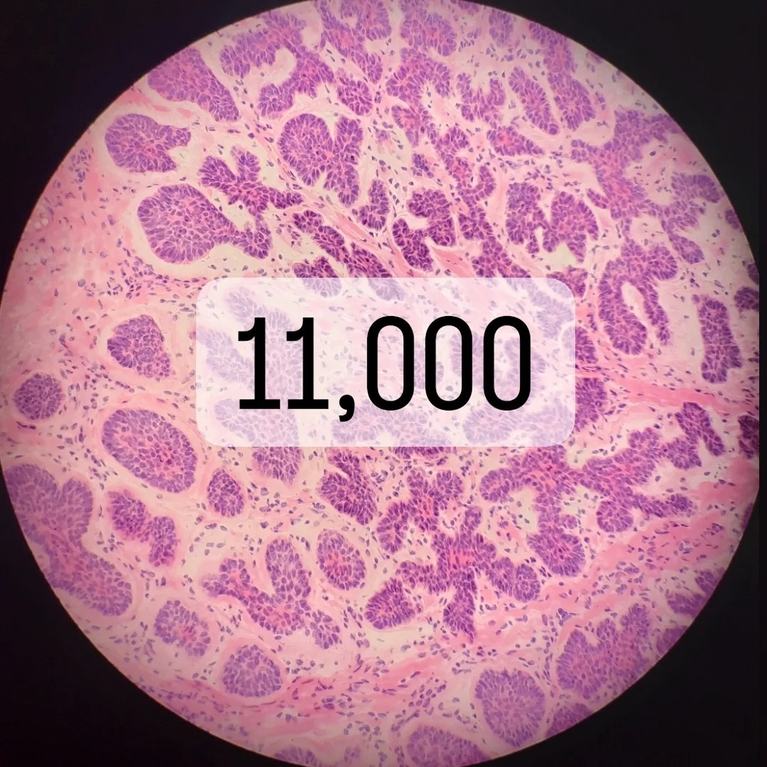 drvitalyt's tweet photo. Today marks 11,000 Mohs surgeries completed since finishing fellowship!

When seeing a Mohs surgeon for your skin cancer, make sure to see someone with experience.  Also, make sure they have graduated from an ACGME-accredited Mohs surgery fellowship. https://t.co/sNbauX5LUt