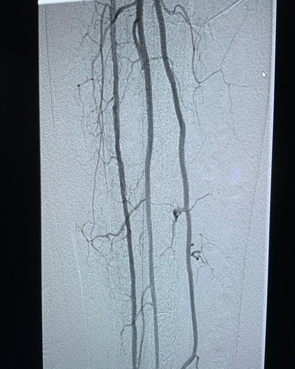 DocIfti's tweet image. Off to a good start, CLI patient with non healing wounds. This (atherectomy and angioplasty) plus optimal medical management. Will see him in clinic in 4 weeks.  @SIRspecialists @Interventional2