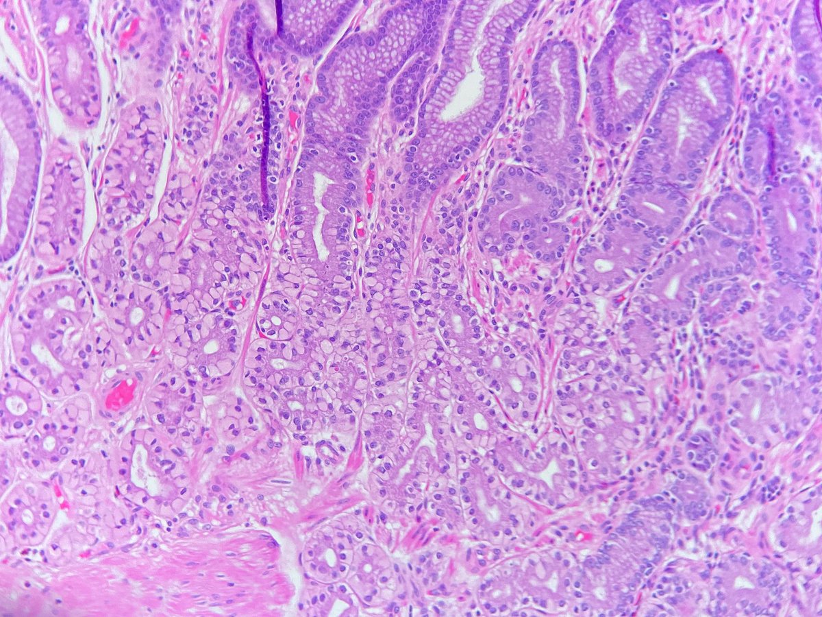 ShackletonMD's tweet image. Still waiting to see a case of gastric signet ring cell carcinoma, despite too long staring at mimics like this 🧐

B9 subnuclear vacuolization of Rubio in a gastric hyperplastic polyp. 

doi.org/10.1002/jso.29…

#pathology