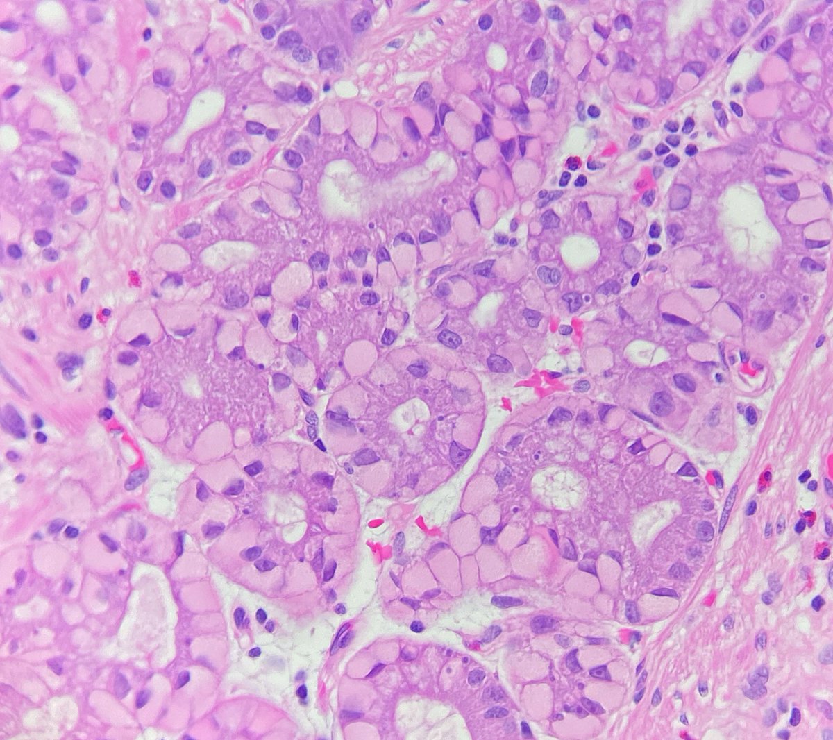ShackletonMD's tweet image. Still waiting to see a case of gastric signet ring cell carcinoma, despite too long staring at mimics like this 🧐

B9 subnuclear vacuolization of Rubio in a gastric hyperplastic polyp. 

doi.org/10.1002/jso.29…

#pathology
