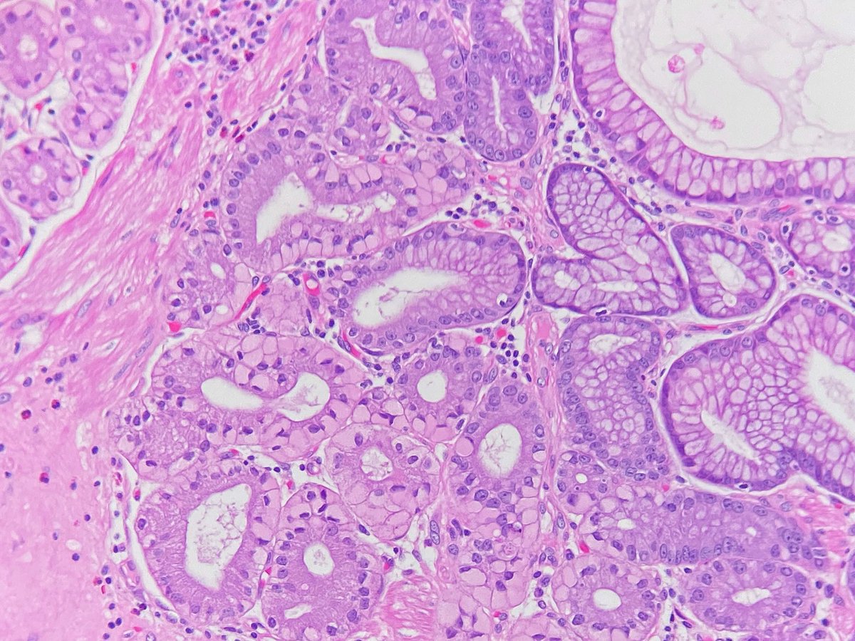 ShackletonMD's tweet image. Still waiting to see a case of gastric signet ring cell carcinoma, despite too long staring at mimics like this 🧐

B9 subnuclear vacuolization of Rubio in a gastric hyperplastic polyp. 

doi.org/10.1002/jso.29…

#pathology