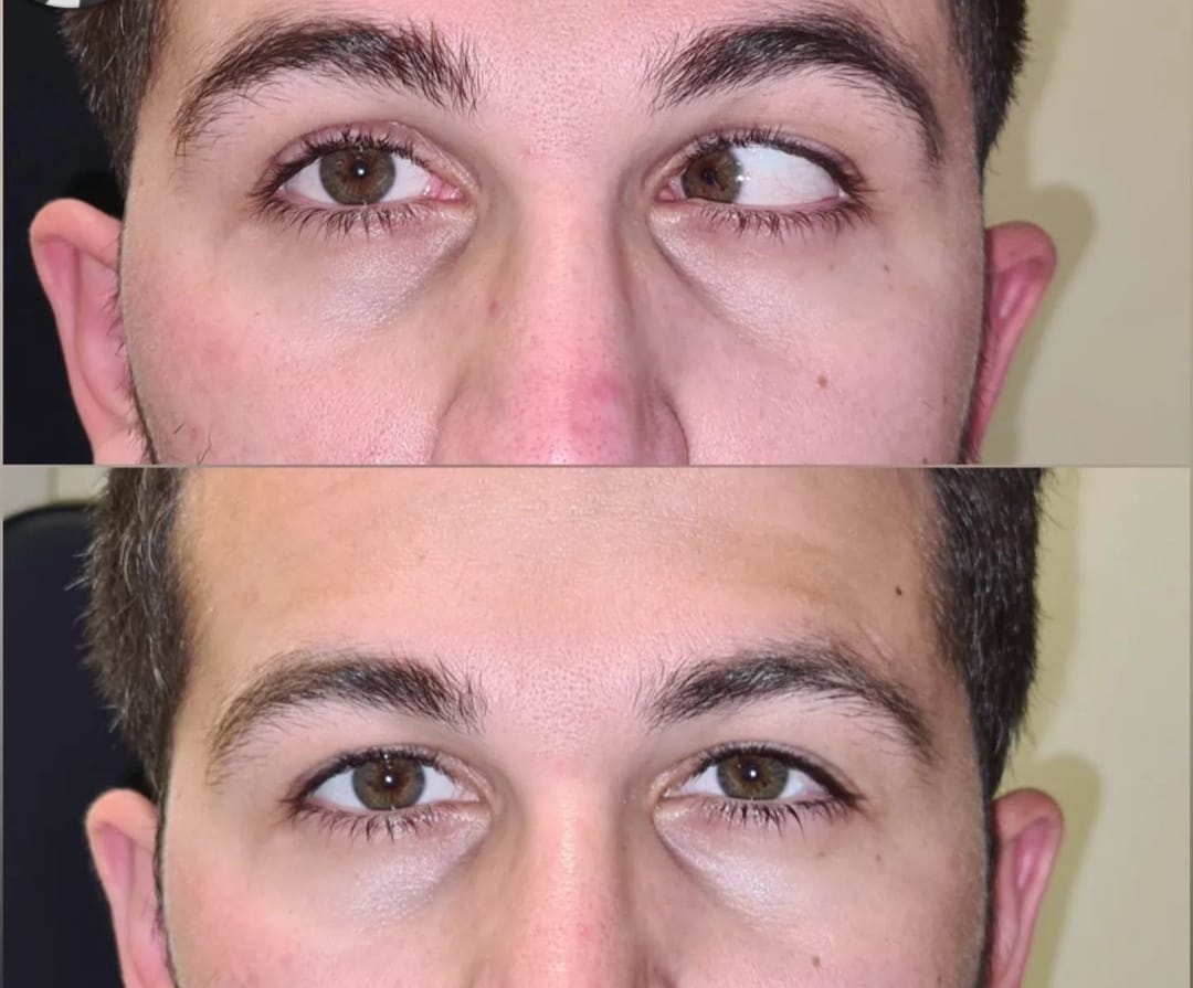 benoit_kasini's tweet photo. Après traitement du strabisme de l'un de nos patients en Turquie
 #AlfajiriMedicalCenterKLM #Strabismus #eyecare #strabisme https://t.co/mW5FWenOFQ https://t.co/xjVm2R1hUp