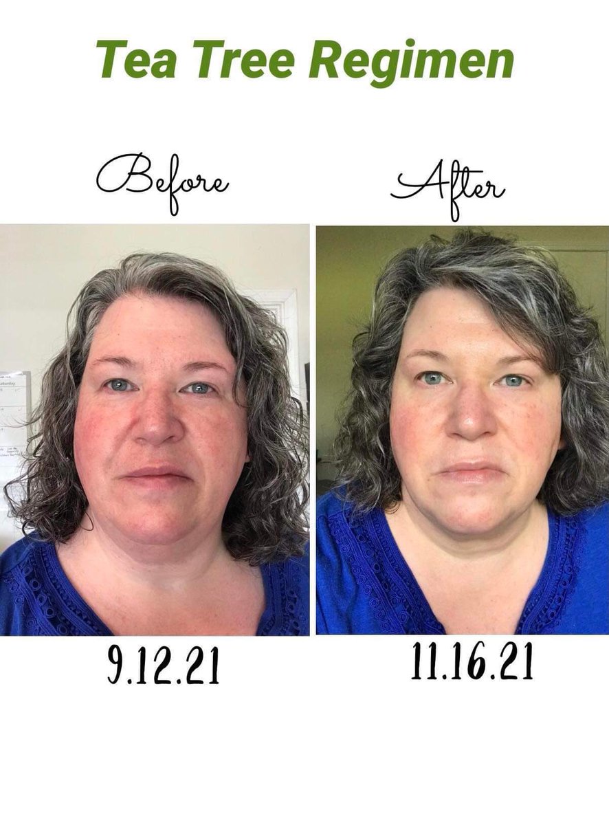 StacyBoswell5's tweet photo. Have oily acne prone skin? This tea tree line not only meets European standards but will also clear up those skin issues! And it’s 20% off until The 21st https://t.co/BH7GmTy9vV