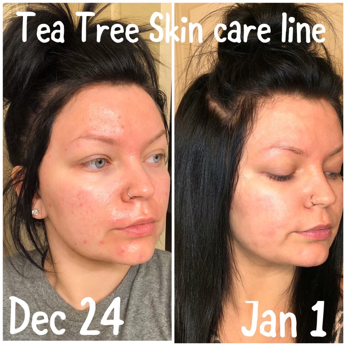 StacyBoswell5's tweet photo. Have oily acne prone skin? This tea tree line not only meets European standards but will also clear up those skin issues! And it’s 20% off until The 21st https://t.co/BH7GmTy9vV
