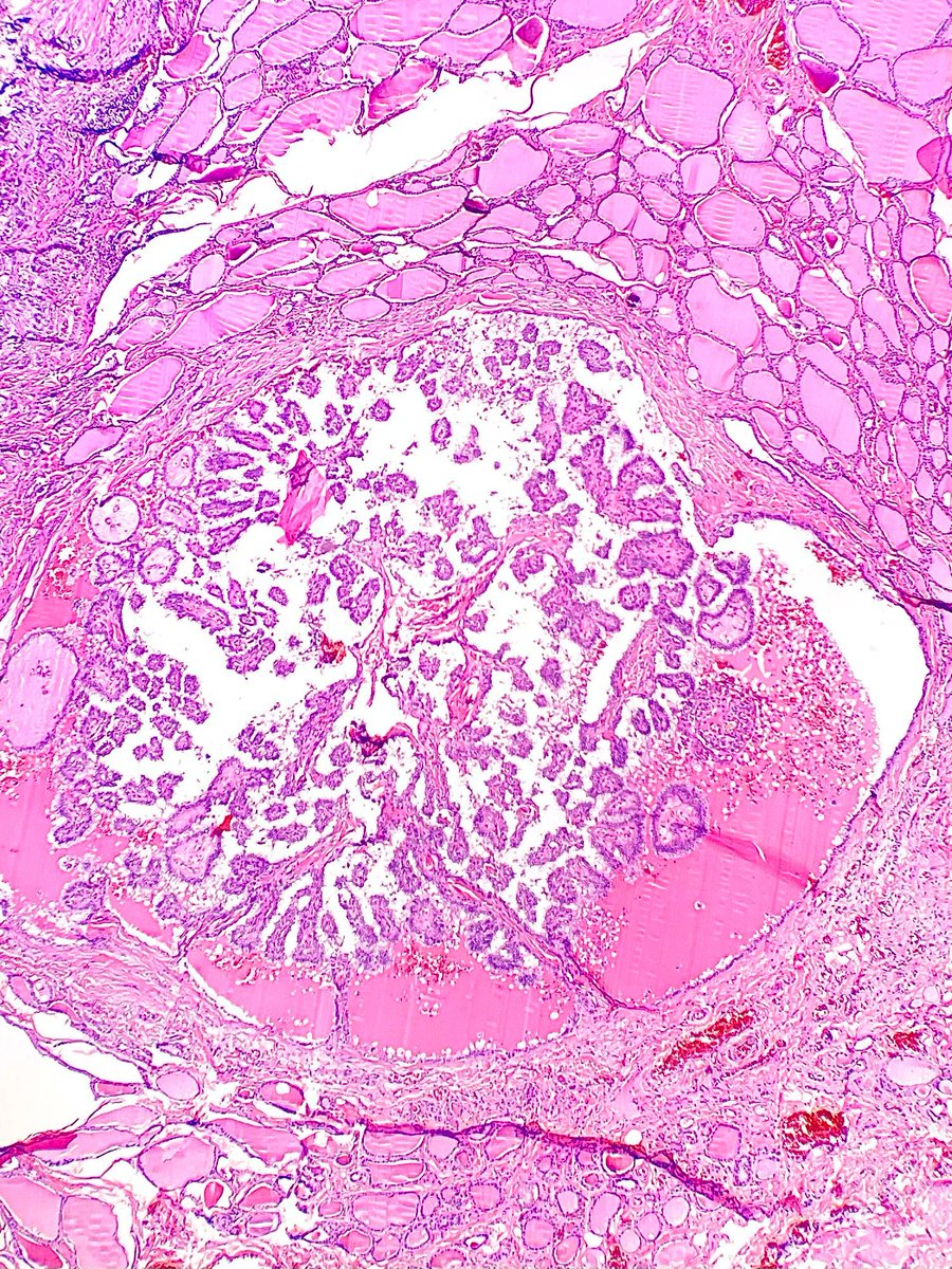 Thyroidectomy specimen revealing an incidental focus of what tumor type? Answer: kikoxp.com/posts/13455  #PathArt #PathTwitter #MedTwitter
