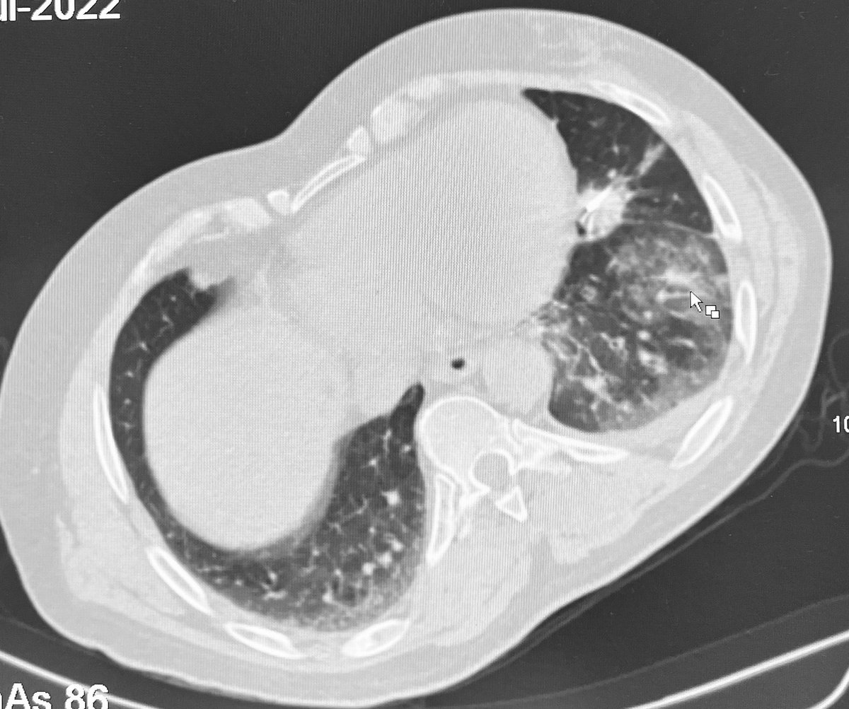 Dr Ajit Yadav (@drajityadav) on Twitter photo Situation where IR heartbeat is more then patient Heart beat
# Difficult Biospy #IR Courage
<a href="/ISVIRIndia/">ISVIR India</a> <a href="/drgauravgangwni/">Dr. Gaurav Gangwani (Interventional Radiologist)</a> @IR_juniors <a href="/SIRRFS/">SIR RFS</a> <a href="/cirsesociety/">CIRSE</a> <a href="/No_cut_surgery/">IIR IRad indore</a> <a href="/RajNarayanan67/">Raj Narayanan</a> <a href="/DrAmeyNarkhede1/">Dr. Amey Narkhede</a> <a href="/Percut_IRad/">Percut</a> <a href="/ImageBiopsyLab/">ImageBiopsy Lab</a> <a href="/keithppereira/">Keith Pereira MD, #VIrad</a> Situation where IR heartbeat is more then patient Heart beat
# Difficult Biospy #IR Courage
<a href="/ISVIRIndia/">ISVIR India</a> <a href="/drgauravgangwni/">Dr. Gaurav Gangwani (Interventional Radiologist)</a> @IR_juniors <a href="/SIRRFS/">SIR RFS</a> <a href="/cirsesociety/">CIRSE</a> <a href="/No_cut_surgery/">IIR IRad indore</a> <a href="/RajNarayanan67/">Raj Narayanan</a> <a href="/DrAmeyNarkhede1/">Dr. Amey Narkhede</a> <a href="/Percut_IRad/">Percut</a> <a href="/ImageBiopsyLab/">ImageBiopsy Lab</a> <a href="/keithppereira/">Keith Pereira MD, #VIrad</a>