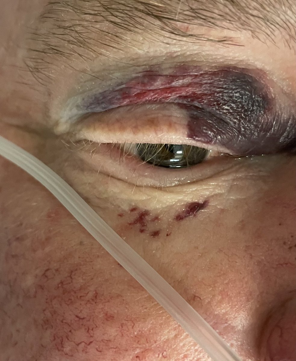 Periorbital purpura after procedure (ablation for atrial arrhythmia).Think light chain amyloidosis (NOT TTR) with capillary fragility and cardiomyopathy ( it was!)