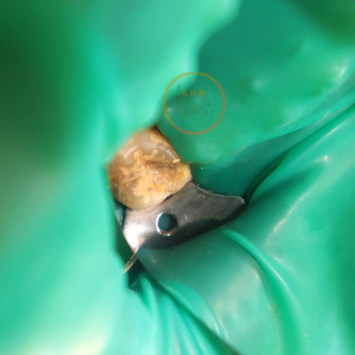 dentist_amar617's tweet photo. RCT for maxilary 2nd molar (17)
Canals Shaped using raceEVO 4%sequence
BC sealer were used
#dent17 #endo #savetooth https://t.co/3ptMmYWIjk
