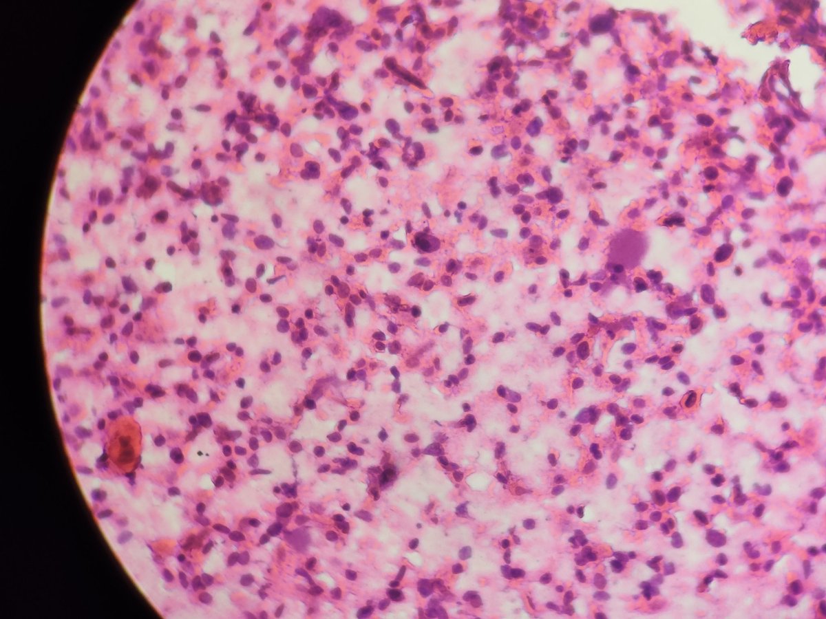 Swetlan52844824's tweet photo. FNAC -76 year male presenting left lateral lymph nodal swelling
On USG thyroid show multiple suspicious nodules. Give ur opinion @JMGardnerMD @atman_ci @DrGeeONE @ankspath https://t.co/YzlrTWiu1I