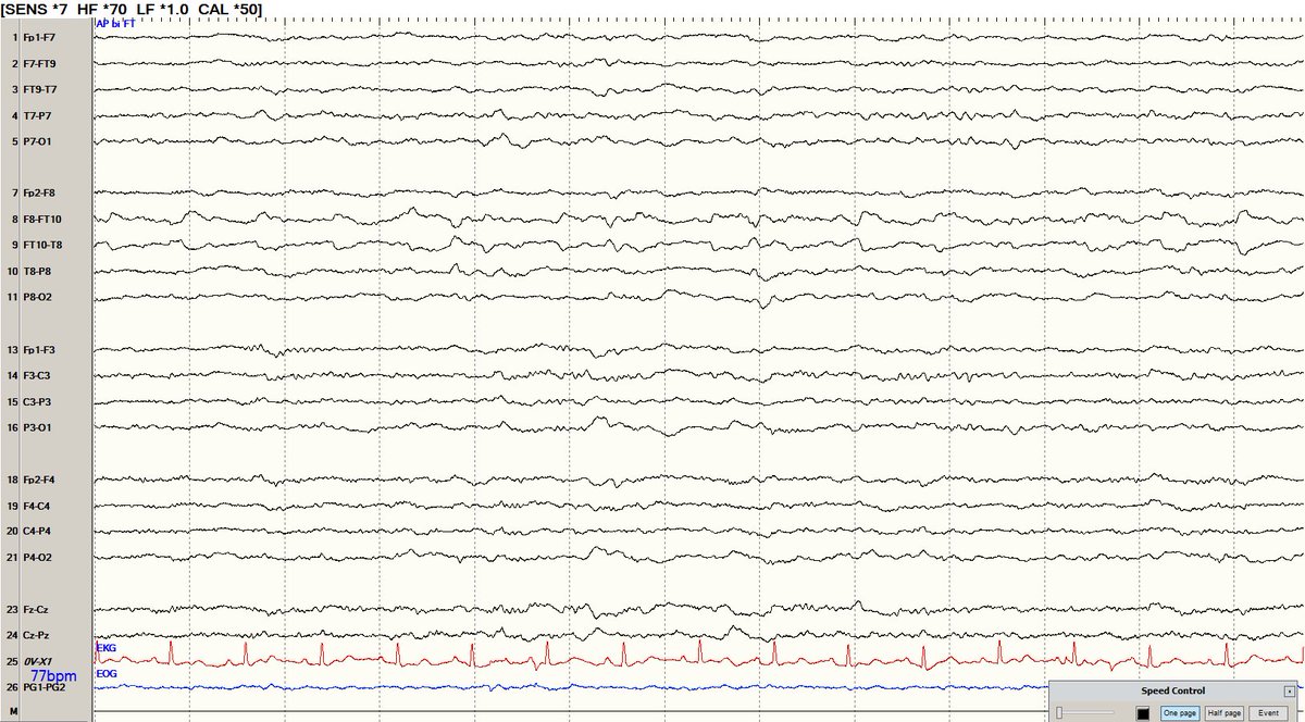#NeuroTwitter #MedTwitter #MedEd
