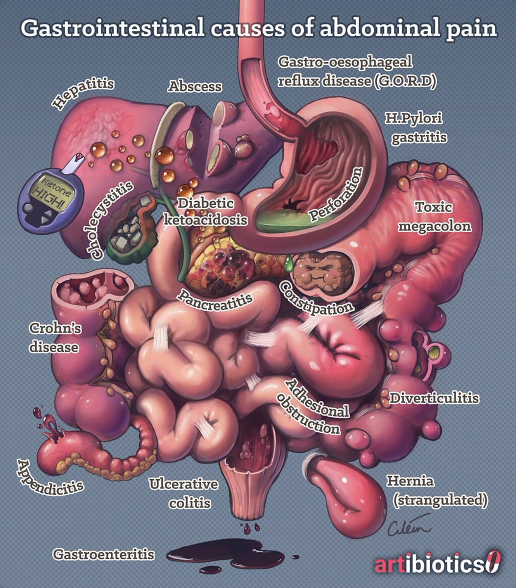 Medical_MD1's tweet photo. Quick Recap 🧐

Differential Diagnosis of Abdominal Pain✨

. https://t.co/kcjCblHkBn