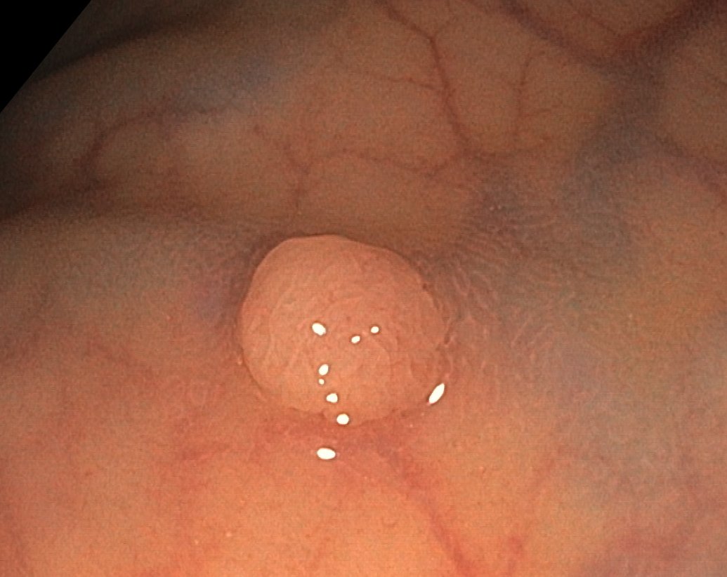 EndoCollab™ | GI Endoscopy Community tweet media
