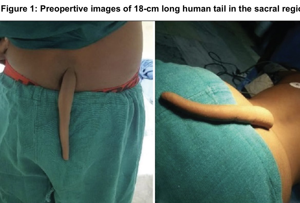 OGdukeneurosurg's tweet photo. Things they don't teach you in med school: HUMAN TAILS are real &amp; many come w/ spinal dysraphisms like
low lying &amp; tethered spinal  cord. Before resecting the tail, get a spine MRI, and be prepared to surgically detether the spinal cord. Thx @DrBrowd for the reminder. https://t.co/WwcLLazDq6