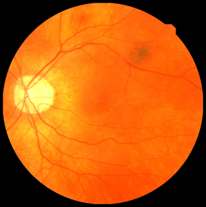 Web: …hthalmology.peersalleyconferences.com
Using the eye as a window into heart disease #ophthamology #regenerativemedicine #lensdisorders #glaucoma #cortex #immunology #nanoopthalmology #biochemistry #ocularoncology #retinalimaging #eye #diabeticretinopathy #cornea #hormones #retina