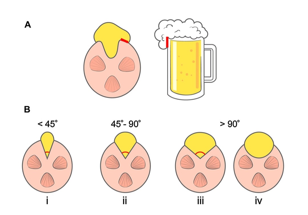 drvigen's tweet photo. "Overflowing beer sign" and "angular interface". New allies helping to differentiate fpAML from RCC, with an excellent negative predictive value. Seems useful and easy to remember. Especially for beer lovers.😉 https://t.co/qWy8TD27Z2
