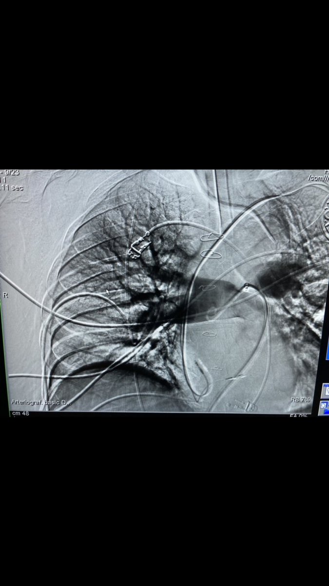JUAN JOSE CIAMPI DOPAZO (@ciampijuanjo) on Twitter photo Masive PE with complete right pulmonary artery blockage and haemodynamic shock.Thrombus removing successfully. Another case using CAT12 Masive PE with complete right pulmonary artery blockage and haemodynamic shock.Thrombus removing successfully. Another case using CAT12