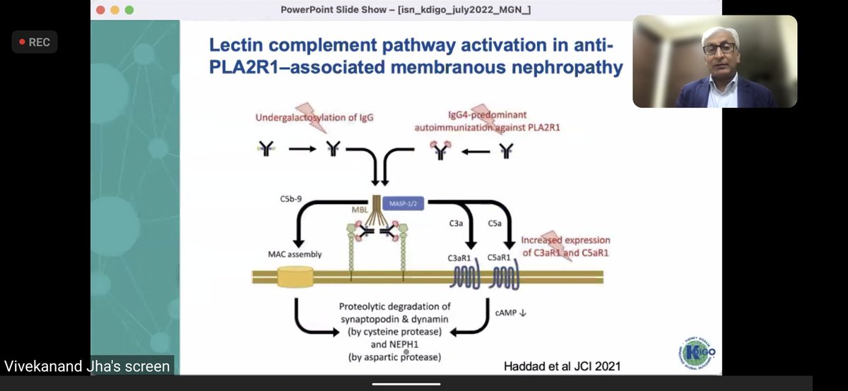 DrSumanBehera's tweet photo. #Lectin complement pathway activation in anti #PLA2R membranous nephropathy
#complement as a disease mediator and treatment target in #MN https://t.co/mtvOyl2lDY