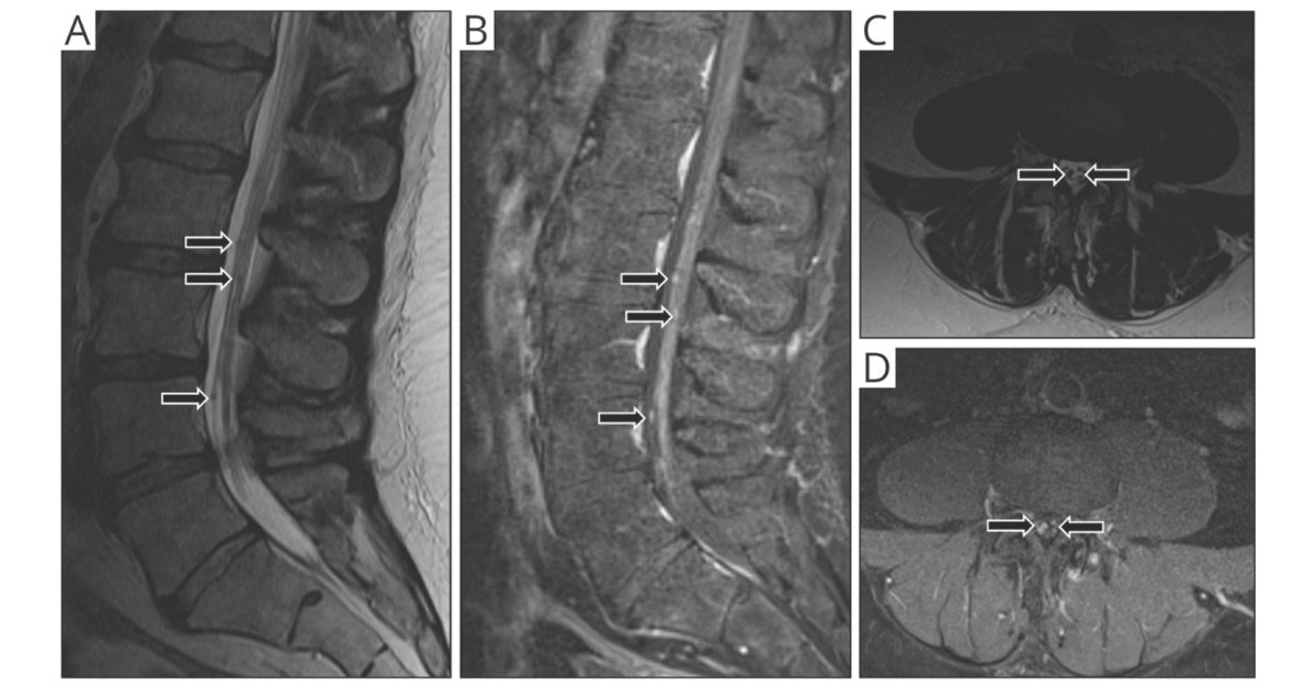 Neurosarcoidosis of the Cauda Equina: Clinical Course, Radiographic and Electrodiagnostic Findings, Response to Treatment, and Outcomes bit.ly/3vnplJZ #NeuroTwitter #Neurology #Sarcoidosis