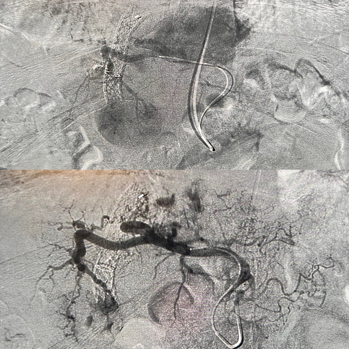 My first TACE 🥲🫶🏼🔥 #IamIR