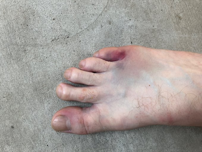 LaydenRobinson's tweet image. How long does it take for a #dislocated toe to #heal? on day 9.